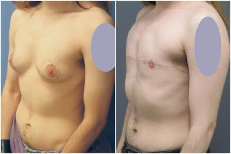 FTM Mastectomy Before & After Gallery - Patient 340792 - Image 3