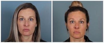 Rhinoplasty Before & After Gallery - Patient 180955 - Image 1