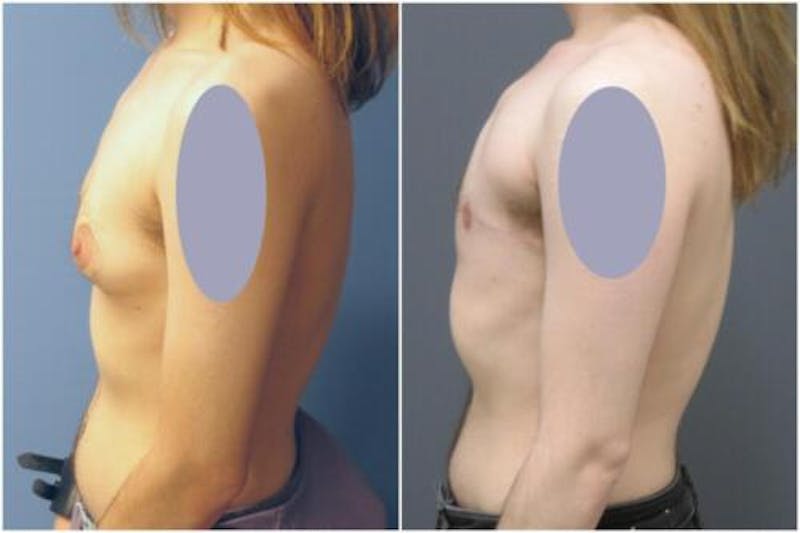FTM Mastectomy Before & After Gallery - Patient 340792 - Image 4