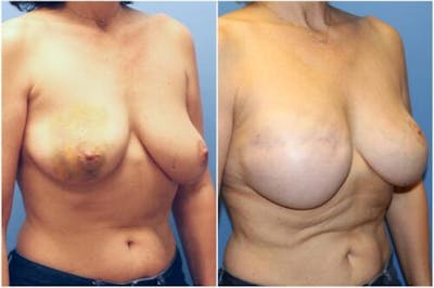 Breast Reconstruction Before & After Gallery - Patient 105769 - Image 2