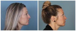 Rhinoplasty Before & After Gallery - Patient 180955 - Image 2
