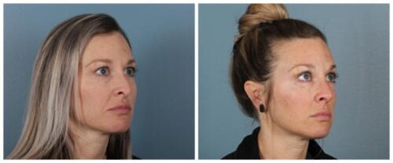 Rhinoplasty Before & After Gallery - Patient 180955 - Image 3
