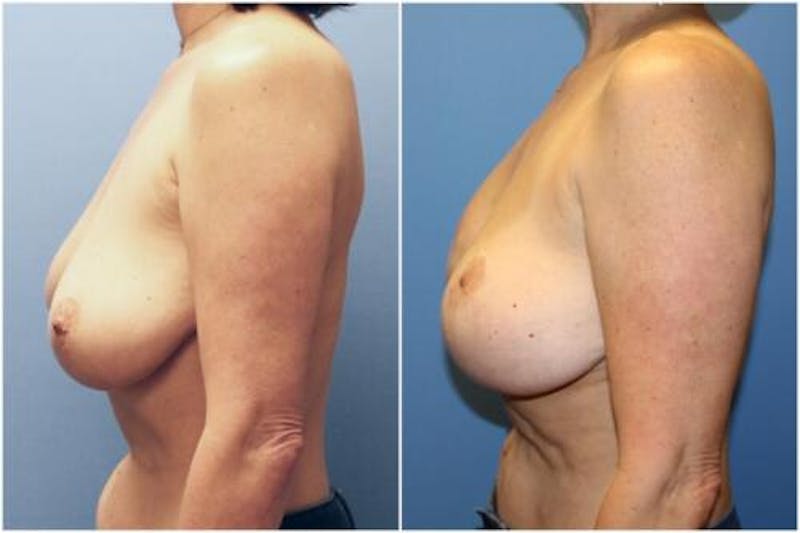 Breast Reconstruction Before & After Gallery - Patient 105769 - Image 4