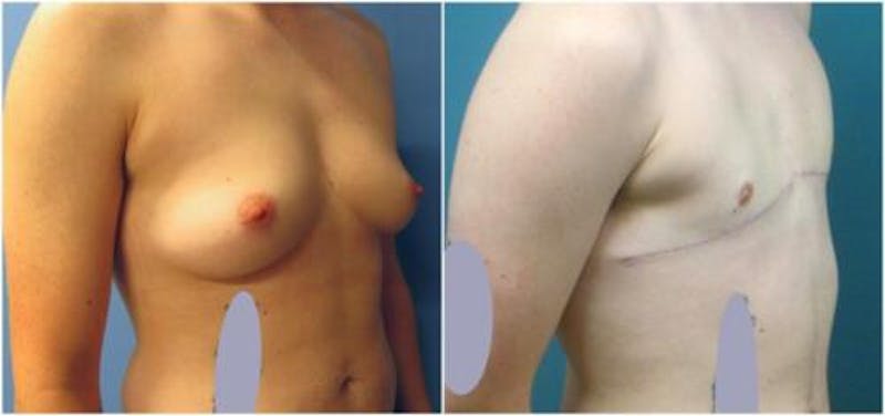 FTM Mastectomy Before & After Gallery - Patient 254278 - Image 2