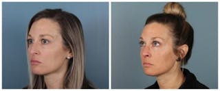Rhinoplasty Before & After Gallery - Patient 180955 - Image 4