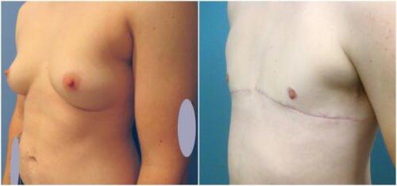 FTM Mastectomy Before & After Gallery - Patient 254278 - Image 3