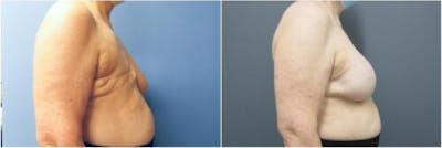 Breast Reconstruction Before & After Gallery - Patient 640812 - Image 1