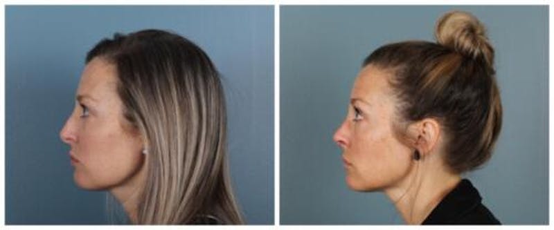 Rhinoplasty Before & After Gallery - Patient 180955 - Image 5