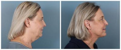Face and Neck Lift Before & After Gallery - Patient 143941 - Image 1
