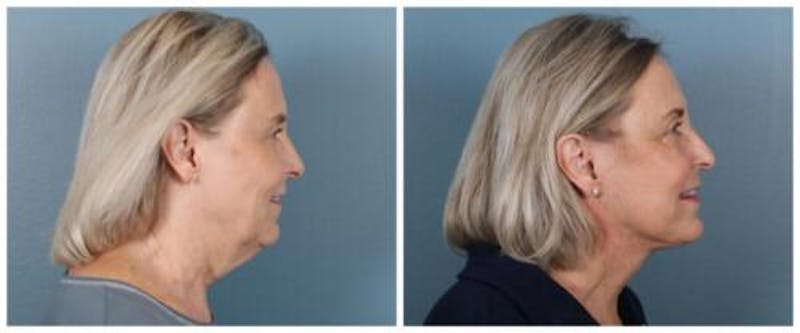 Face and Neck Lift Before & After Gallery - Patient 143941 - Image 1