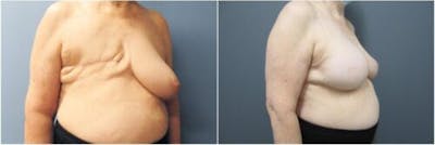 Breast Reconstruction Before & After Gallery - Patient 640812 - Image 2
