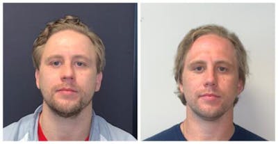 Rhinoplasty Before & After Gallery - Patient 758102 - Image 1