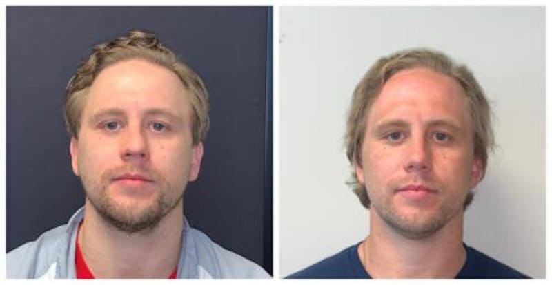 Rhinoplasty Before & After Gallery - Patient 758102 - Image 1