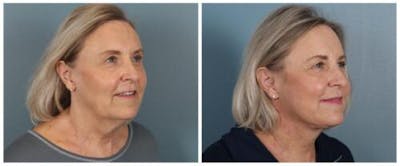 Face and Neck Lift Before & After Gallery - Patient 143941 - Image 2