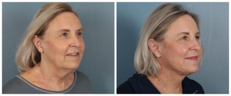 Face and Neck Lift Before & After Gallery - Patient 143941 - Image 2
