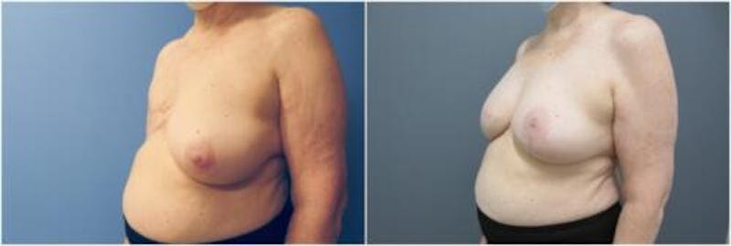 Breast Reconstruction Before & After Gallery - Patient 640812 - Image 3