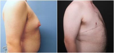 FTM Mastectomy Before & After Gallery - Patient 783222 - Image 1