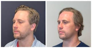 Rhinoplasty Before & After Gallery - Patient 758102 - Image 2