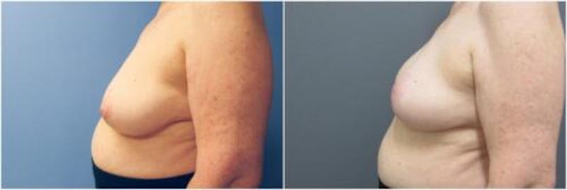 Breast Reconstruction Before & After Gallery - Patient 640812 - Image 4
