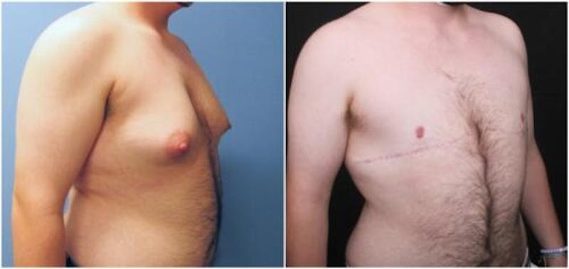 FTM Mastectomy Before & After Gallery - Patient 783222 - Image 2