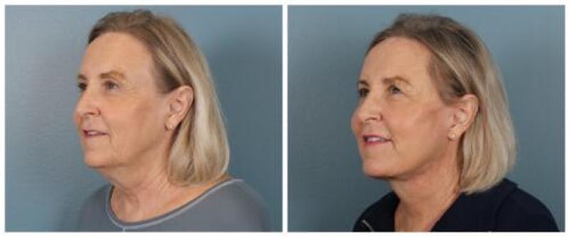 Face and Neck Lift Before & After Gallery - Patient 143941 - Image 3