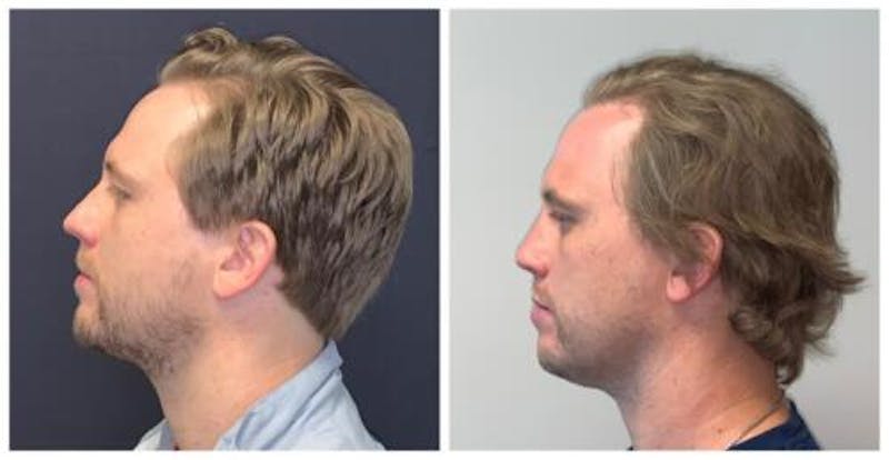 Rhinoplasty Before & After Gallery - Patient 758102 - Image 3
