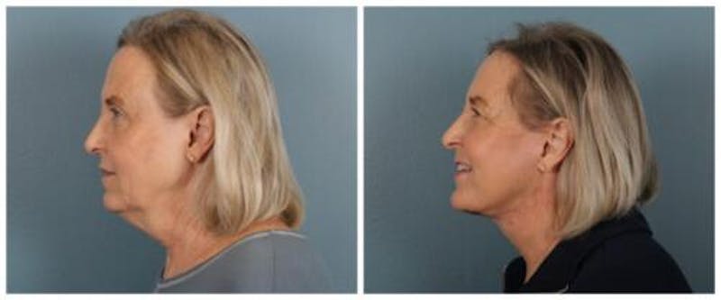 Face and Neck Lift Before & After Gallery - Patient 143941 - Image 4