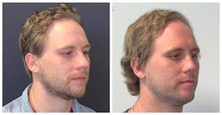 Rhinoplasty Before & After Gallery - Patient 758102 - Image 4