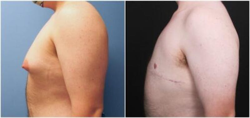 FTM Mastectomy Before & After Gallery - Patient 783222 - Image 4