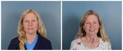Face and Neck Lift Before & After Gallery - Patient 139605 - Image 1