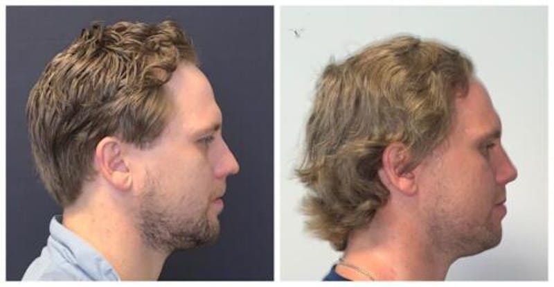 Rhinoplasty Before & After Gallery - Patient 758102 - Image 5