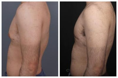 Gynecomastia Before & After Gallery - Patient 312824 - Image 1