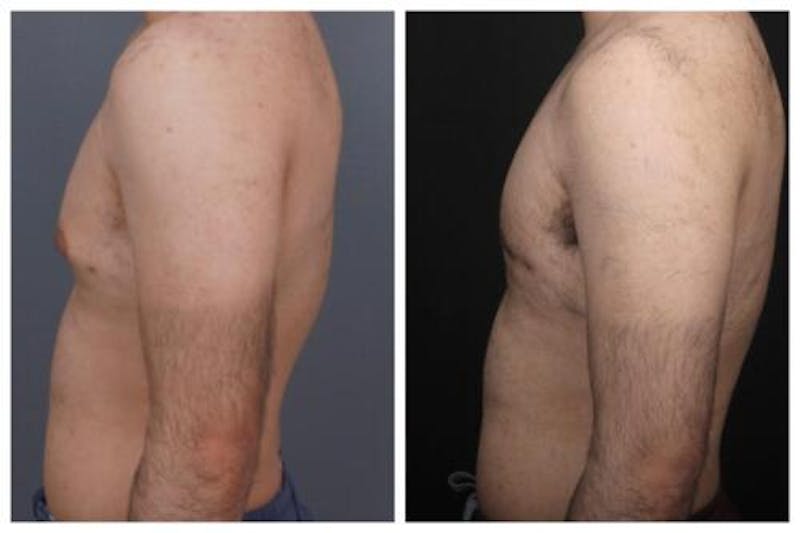 Gynecomastia Before & After Gallery - Patient 312824 - Image 1