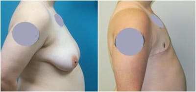 FTM Mastectomy Before & After Gallery - Patient 366918 - Image 1