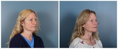 Face and Neck Lift Before & After Gallery - Patient 139605 - Image 2