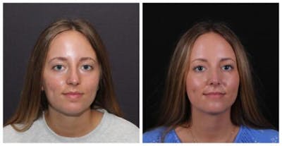 Rhinoplasty Before & After Gallery - Patient 353078 - Image 1