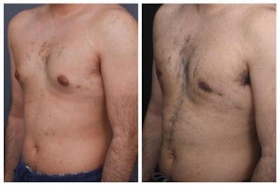 Gynecomastia Before & After Gallery - Patient 312824 - Image 2