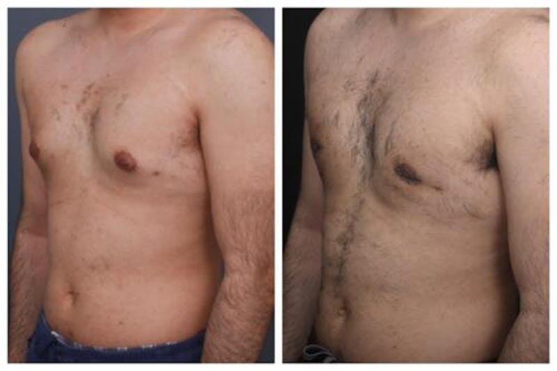 Gynecomastia Before & After Gallery - Patient 312824 - Image 2