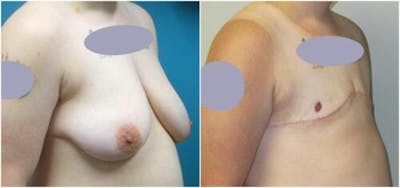 FTM Mastectomy Before & After Gallery - Patient 366918 - Image 2