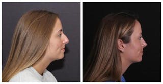 Rhinoplasty Before & After Gallery - Patient 353078 - Image 2