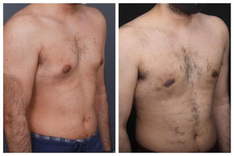Gynecomastia Before & After Gallery - Patient 312824 - Image 3