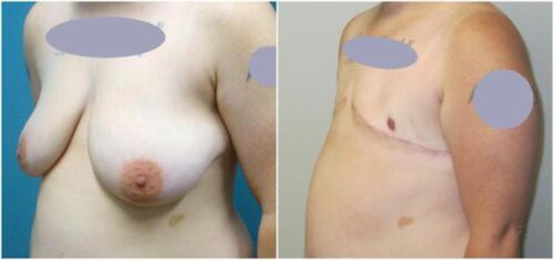 FTM Mastectomy Before & After Gallery - Patient 366918 - Image 3