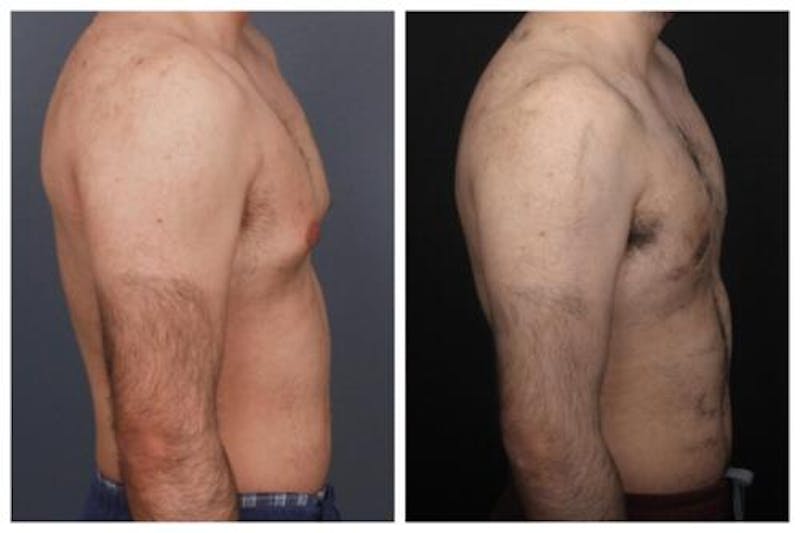 Gynecomastia Before & After Gallery - Patient 312824 - Image 4