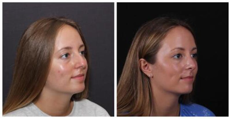 Rhinoplasty Before & After Gallery - Patient 353078 - Image 3