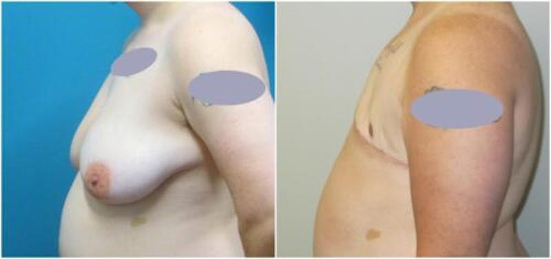 FTM Mastectomy Before & After Gallery - Patient 366918 - Image 4