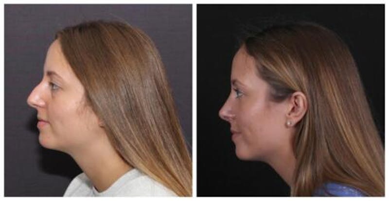Rhinoplasty Before & After Gallery - Patient 353078 - Image 4