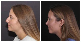 Rhinoplasty Before & After Gallery - Patient 353078 - Image 4