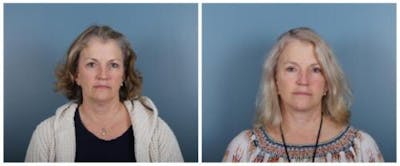 Face and Neck Lift Before & After Gallery - Patient 246788 - Image 1