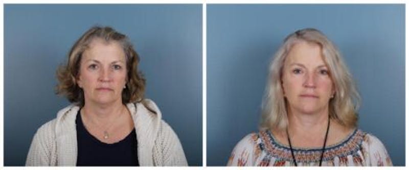 Face and Neck Lift Before & After Gallery - Patient 246788 - Image 1