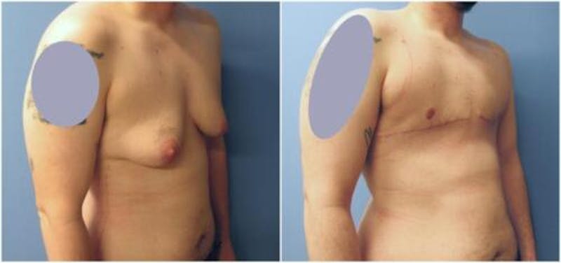 FTM Mastectomy Before & After Gallery - Patient 324189 - Image 1